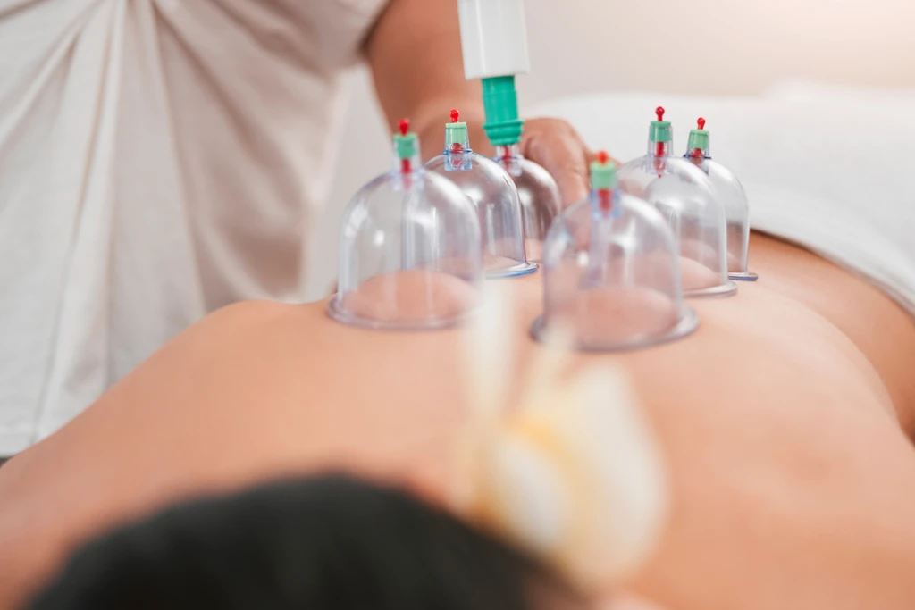 Heathfield Acupuncture Cupping